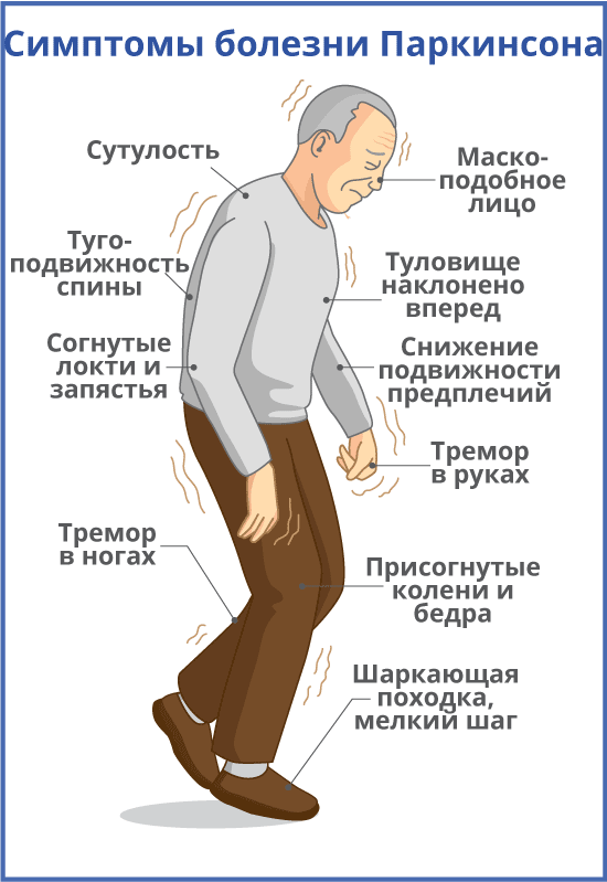 Симптомы болезни паркинсона