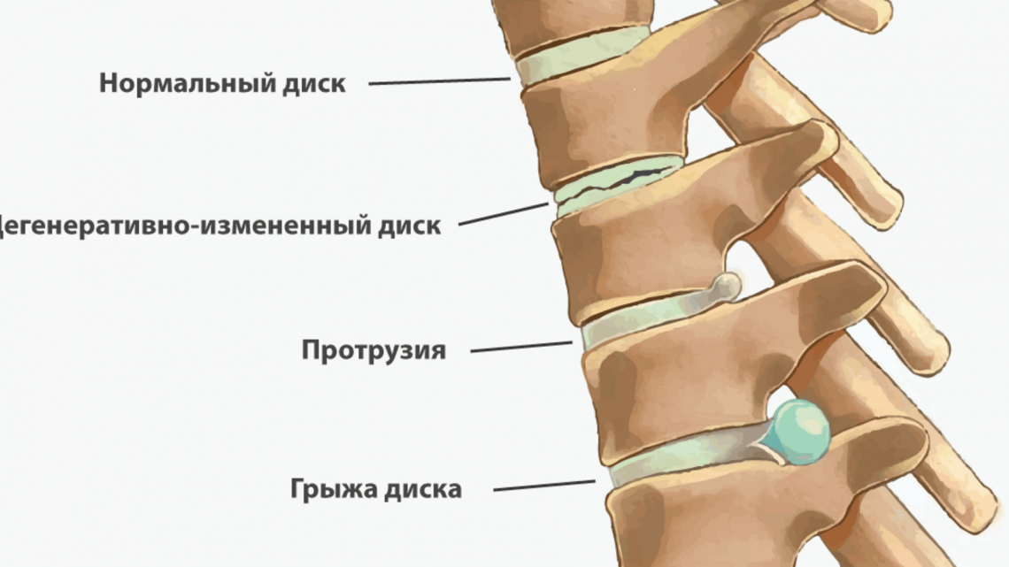 lechenie protruzii gryzhi mezhpozvonochnyh diskov poyasnichnogo otdela