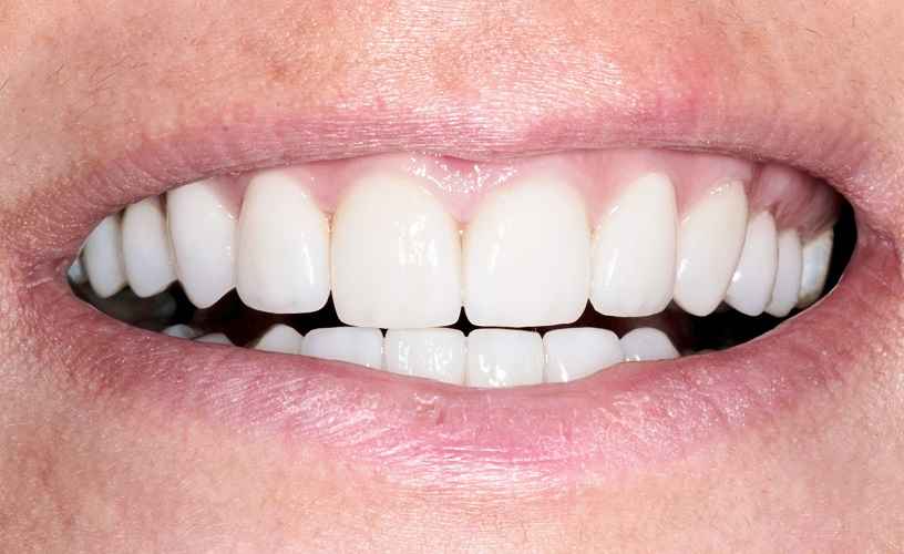 Керамические виниры: Путь к идеальной улыбке и правильные шаги к ней